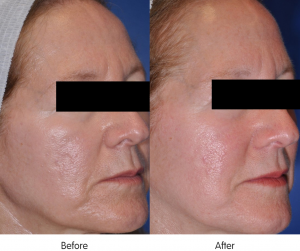 Before and after MegaPeel results